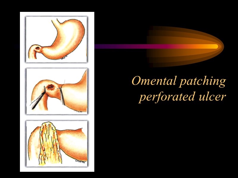 Omental patching perforated ulcer